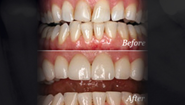 Veneers Dentistry in Prince George - Accent Dental Features Services